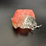 Palatal obturator used for dental restorations by Global Dental Solutions in Atlanta, GA 