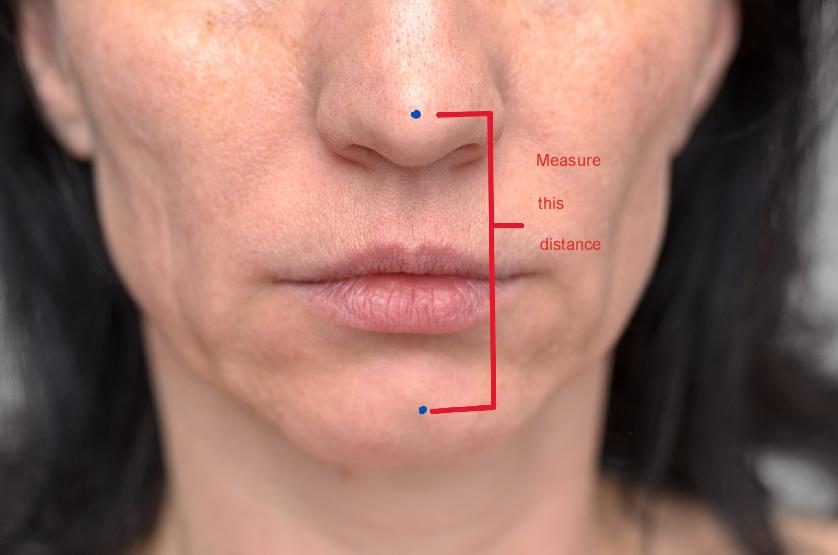 A patient is undergoing a measurement of the Vertical Dimension (VD) of an existing denture