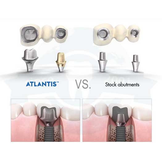 Atlantis vs Stock Abutment
