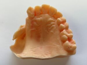 An Example of an obturator for the upper posterior right quadrant at Global Dental Solutions 