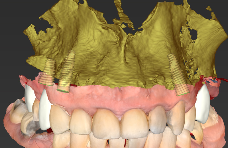 Dental Implant