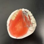 An obturator for the upper right quadrant and palate.