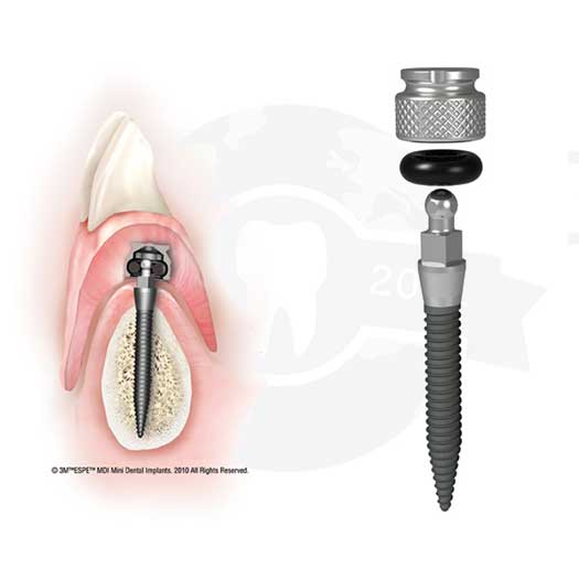 Mini Dental Implant