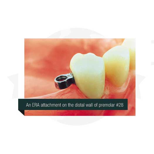 An ERA attachment on the distall wall of a patient in Atlanta, GA 