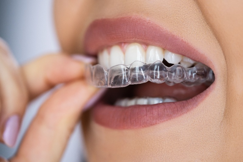 A Person Wearing a Clear Dental Aligner