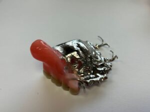 Palatal obturator for dental restorations by Global Dental Solutions in Atlanta, GA 