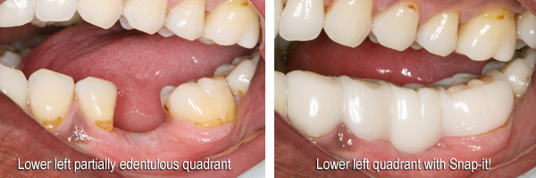 Snap-On Smile and Snap-it